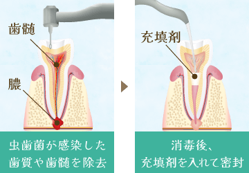 虫歯菌が感染した歯質や歯髄を除去→消毒後、充填液を入れて密封