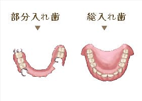 部分入れ歯・総入れ歯