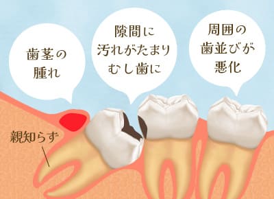 歯茎の汚れ・隙間に汚れがたまり虫歯に・周囲の歯並びが悪化